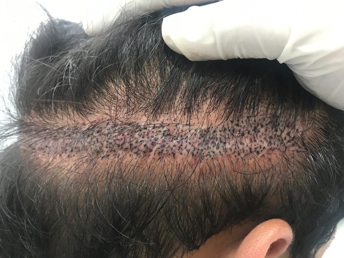 Guide to the benefits of a hair transplant surgery post thumbnail image